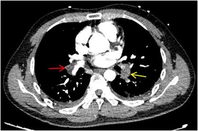 Case Report: PROS1 (c.76+2_76+3del) pathogenic mutation causes pulmonary embolism